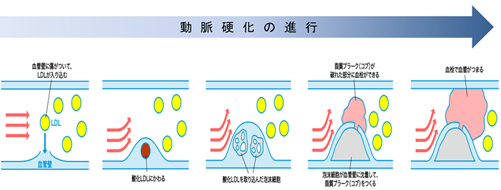 動脈硬化